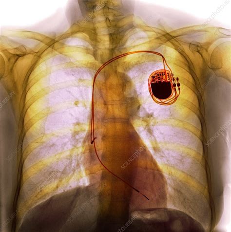 Dual Chamber Pacemaker X Ray Stock Image F0083508 Science Photo