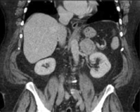Pseudotumorous Adrenalitis Coronal Ct Scan Shows An Adrenal Mass