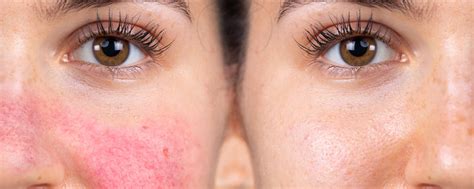 Lupus Rash Vs Rosacea The True Cause Of Facial Redness