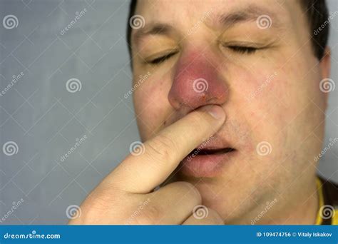 Pimple On The Nose Hurts And Itches Stock Photo Image Of