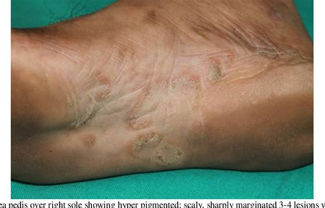 Figure 1 From Primary Cutaneous Aspergillosis Tinea Pedis Caused By