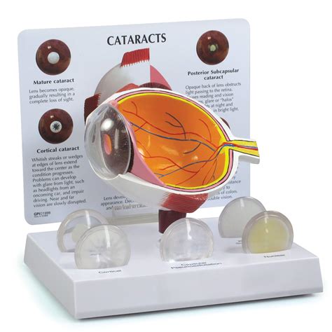 Buy Cataract Eye Anatomical Model Set Of 5 W Educational Key Card