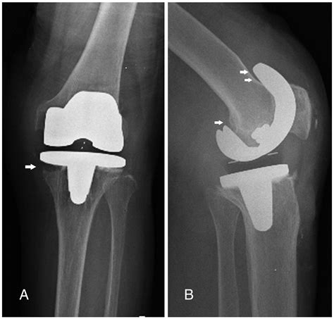 Revision Total Knee Arthroplasty Using A Constrained Condylar Knee