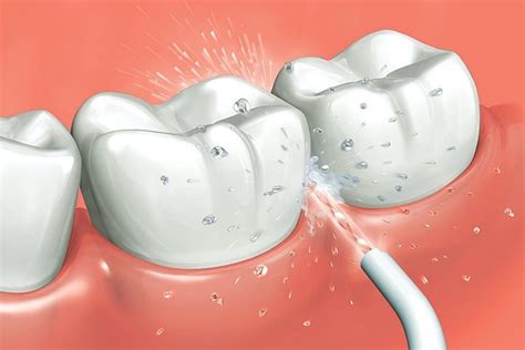 ¿qué Es Un Irrigador Dental Y Cómo Funciona Dental Tutor