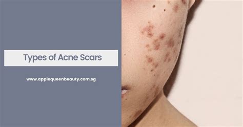 Types Of Acne Scars Everything You Need To Know