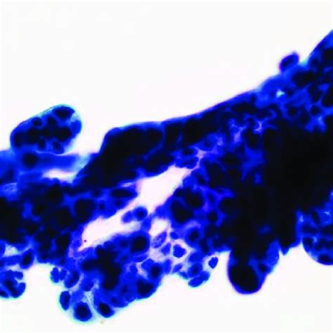 Bile Duct Brushing Specimen Showing Clusters Of Atypical Epithelial