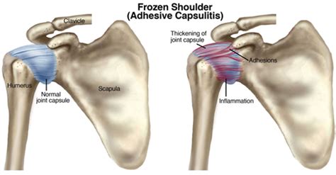 And human body sore joints concept as skeleton and muscle anatomy as a painful injury or arthritis illness for health care and medical. Frozen Shoulder Treatment North Vancouver