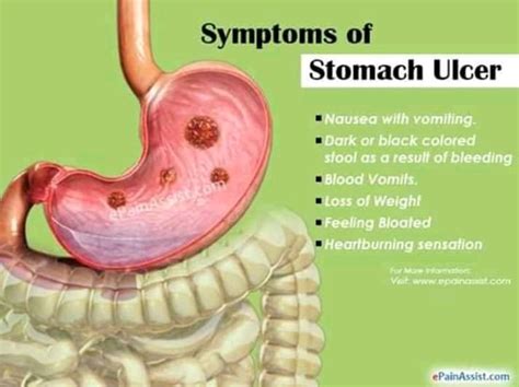Complications Of Stomach Ulcer Foods To Avoid Grace Ngo Foundation