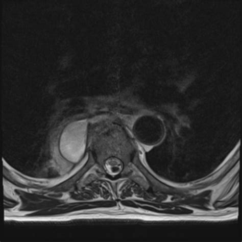 Thoracic Paravertebral Abscess And Osteomyelitis Image