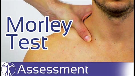 Morley Test Brachial Plexus Compression Test Thoracic Outlet