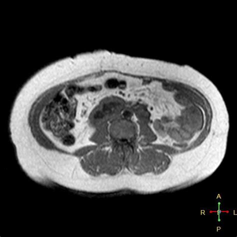 Horseshoe Kidney With Hypoplastic Left Moiety Image