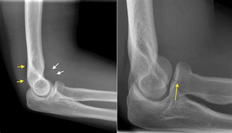 Radial Head Fracture Radiology At St Vincents University Hospital