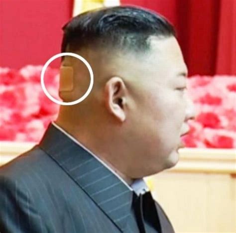 Kim Jong Un Spotted With Plaster On Back Of Head Sparking Fresh Health Concerns Ladun Liadis News