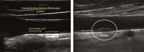 Carotid Artery Plaque Ultrasound