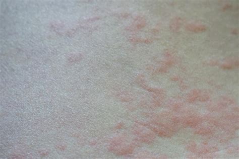 Effective Ways To Get Rid Of Hives