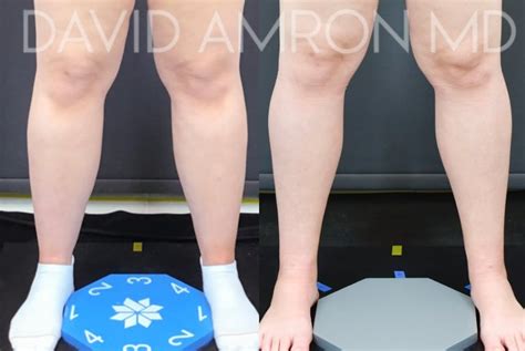 Patient 45365778 Calves And Ankles Before And After Photos David Amron Md