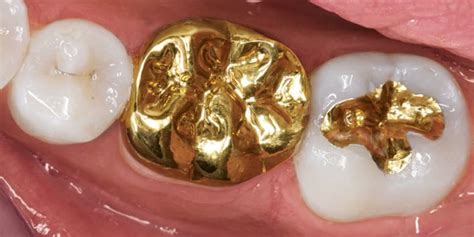 Contact our office in the salt lake and utah salt lake county and utah county patients who have their wisdom teeth extracted in their teens can avoid these we're here for you every step of the way. Dental Gold Teeth Prices In South Africa - TeethWalls