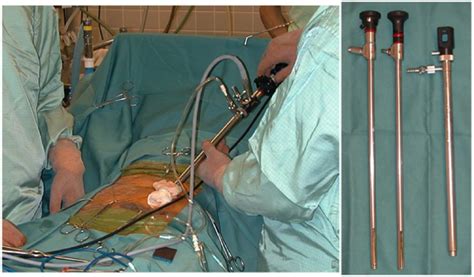 Peritoneal Dialysis Catheter Insertion