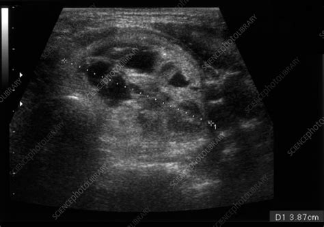 Thyroid Nodule Ultrasound Scan Stock Image C0552884 Science