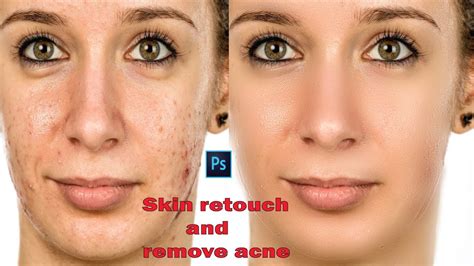 Skin Retouch And Remove Acne In Adobe Photoshop Youtube