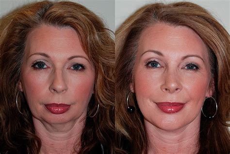 Chin Implants Before And After Artemedica