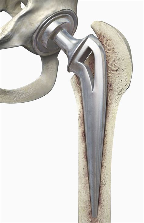 Pin On Hip Replacement
