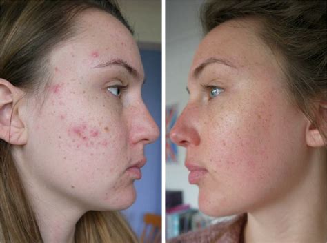 Back Acne Before And After Accutane