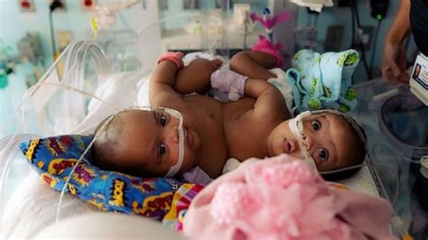 Conjoined Twin Sisters Undergo Successful Surgery To Separate Good