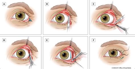 Single Stage Repair Of Paralytic Ectropion Using A Novel Modification
