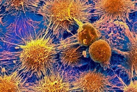 Kidney Cancer Spreads By Pretending To Be White Blood Cells New Scientist