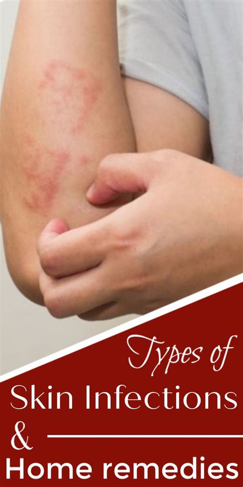 Types Of Skin Infections You May Face What Causes Them And Effective