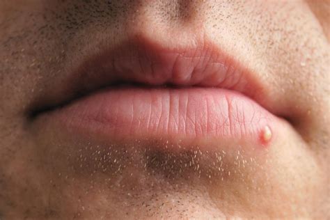 Cold Sore Vs Pimple Differences Similarities And Treatment