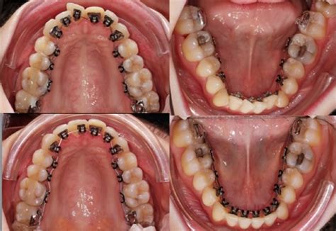 Though you will go through a lot of pain in either probably outer one will be less painful than inner braces. Lingual Orthodontics | Lingual Orthodontic Braces Ireland