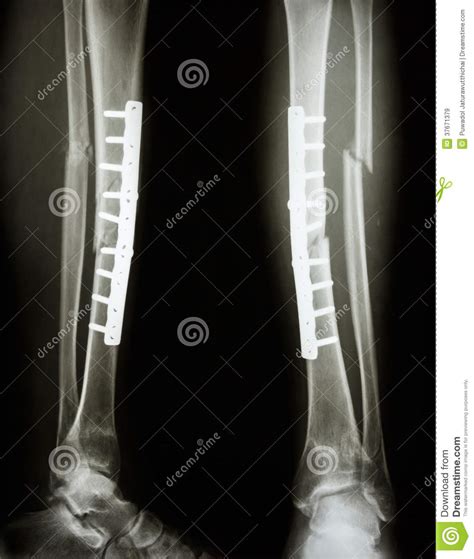 Asse Di Frattura Della Tibia E Del Perone Immagini Stock ...
