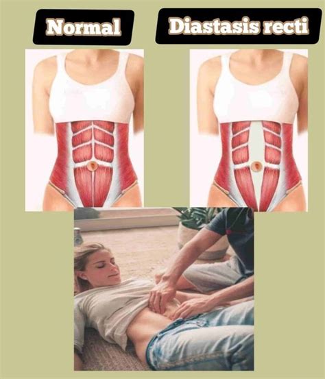 I have great muscle tone everywhere else and workout regularly. Normal vs. Diastasis recti | Diastasis recti, Mommy tummy ...