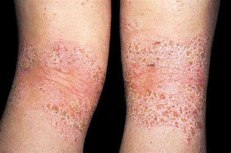 Is It Dry Skin Or Atopic Dermatitis Itching Skin Itchy Rash Skin Rash Dry Skin Symptoms