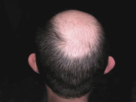 This New Stem Cell Topical Solution For Baldness Has Excellent Results