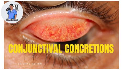 Conjunctival Concretions What Are They Eye Dr Explains Youtube