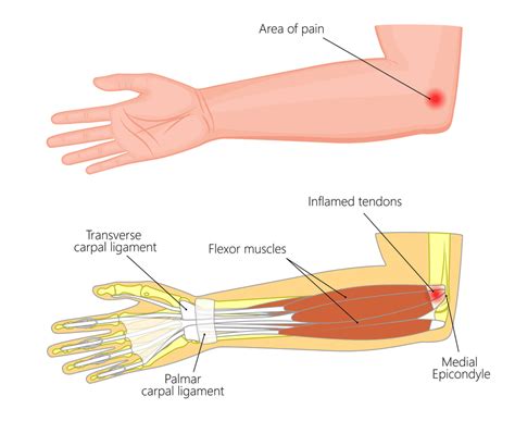 Elbow Injuries And Conditions Aptiva Health