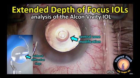 Extended Depth Of Focus Iols Edof Lens For Cataract Surgery Alcon Vivity Youtube