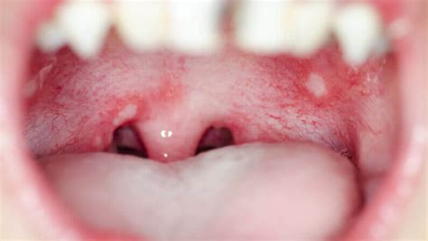 White Spots On Throat Causes And Treatments Kingwood Er