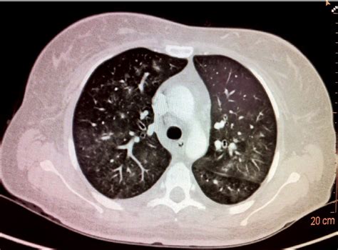 Scielo Brasil Pulmonary Kaposis Sarcoma In A Female Patient Case