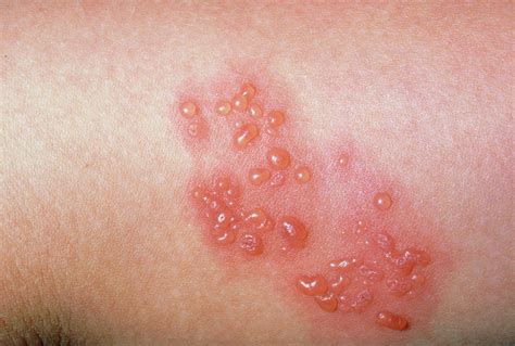 Shingles Close Up Of Blisters Photograph By Dr P Marazziscience