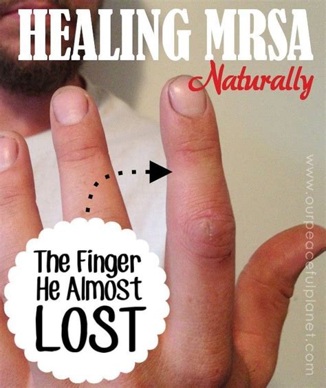 Mrsa Staph Infection Healed Naturally Essential Oil For Infection