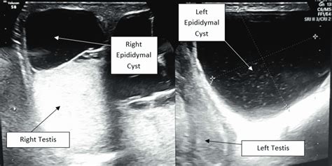 Cureus Asymptomatic Bilateral Giant Multilocular Epididymal Cyst In A Middle Aged Patient