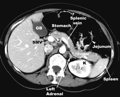 But if a needle biopsy is needed, most doctors prefer to use it might be especially useful for spotting cancer that has spread beyond the pancreas and wouldn't be treatable by surgery. Pancreatic cancer
