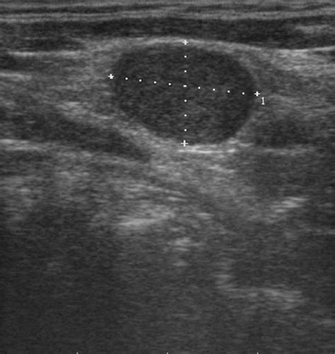 Ultrasonographic Differentiation Of Benign From Malignant Neck