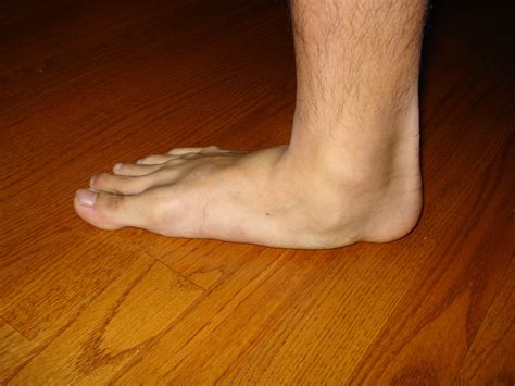 What Is An Accessory Navicular Syndrome Almawi Limited The Holistic Clinic