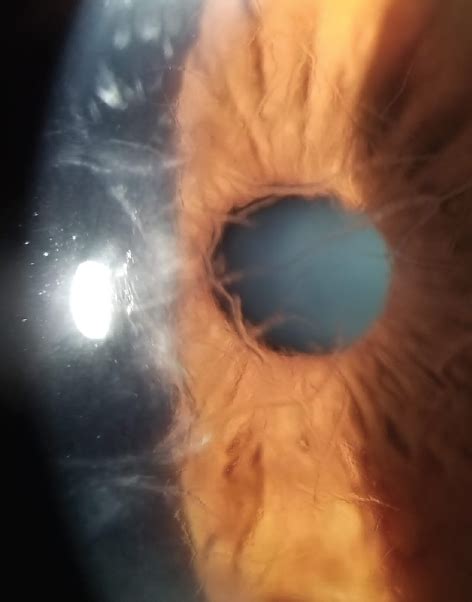 Corneal Dystrophies 101 Modern Optometry