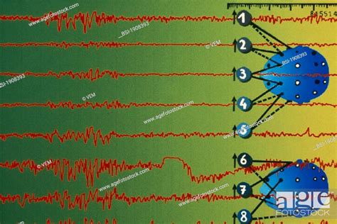 Epilepsy Eeg A Sudden Simultaneous Abnormal Electrical Discharge Of